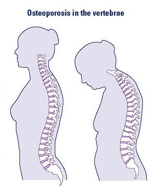 Osteoporosis in the vertebrae