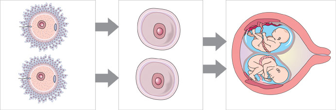 dibujo de dos óvulos distintos fecundados por dos espermatozoides diferentes